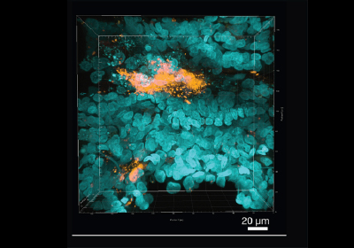 Bacterial biofilm in CF lung tissue.