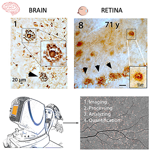 First Identification and Noninvasive Imaging of Pathological Hallmarks of AD: Aβ Plaques in the Retina