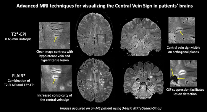 Advanced MRI techniques for visualizing the Central Vein Sign in patients' brains