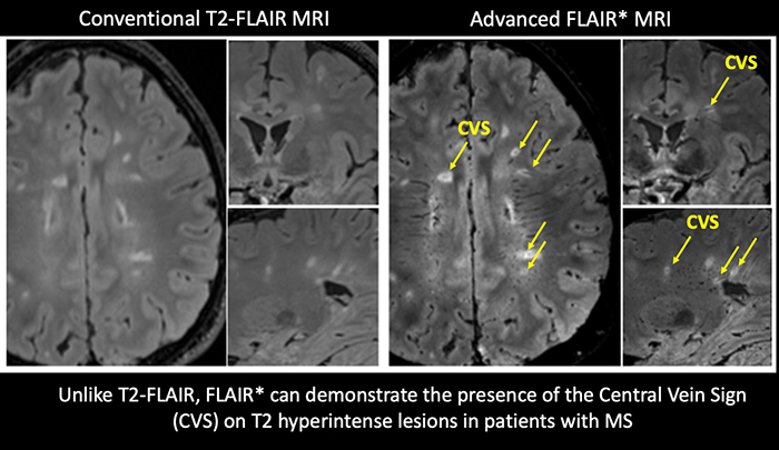 T2 hyperintense lesions detected on T2-FLAIR demonstrate the presence of the Central Vein Sign (CVS) on FLAIR* in this patient diagnosed with MS
