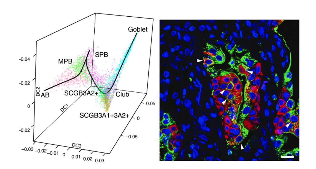 Single cell RNA-Seq reveals the unique molecular phenotype of epithelial cells from lung tissue of IPF patients.