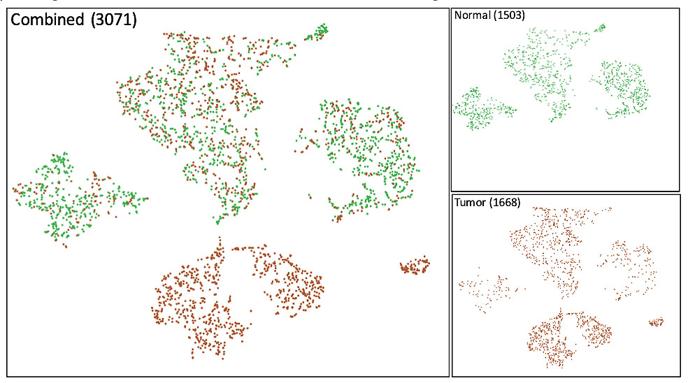 Single cell RNA-Seq reveals tumor cell heterogeneity in stage 3 lung adenocarcinoma.