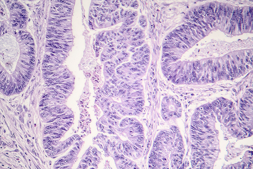 Esophageal squamous cell carcinoma, light micrograph, photo under microscope