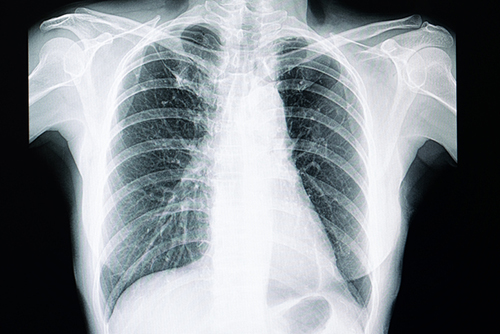 X-ray of chest.